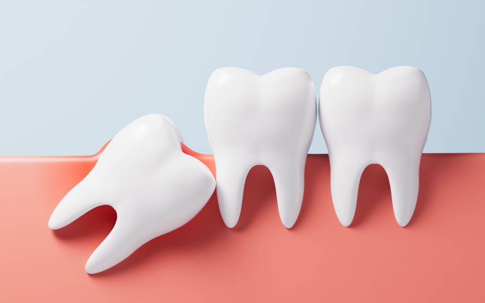 Impacted wisdom tooth beside molars illustration.